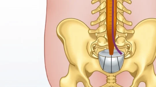 tethered-spinal-cord-symptoms-in-infants
