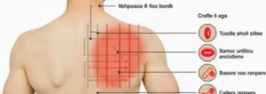 tingling-under-the-left-shoulder-blade-causes