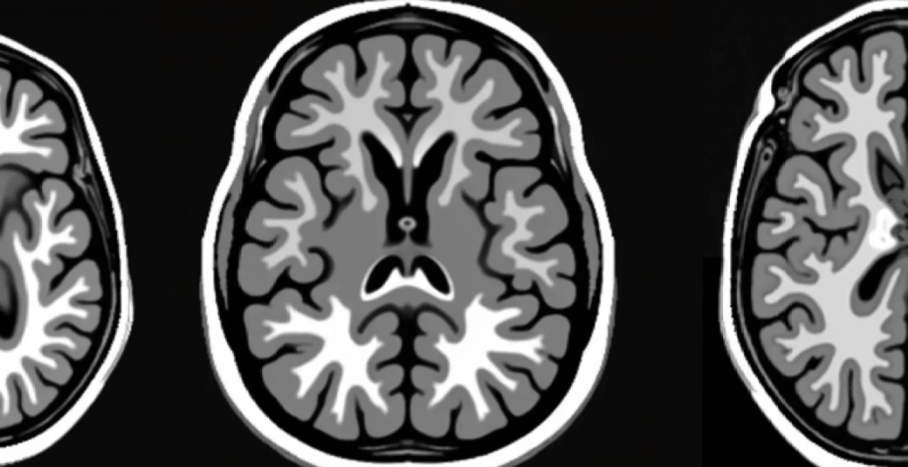 what-white-spots-on-a-brain-mri-may-indicate