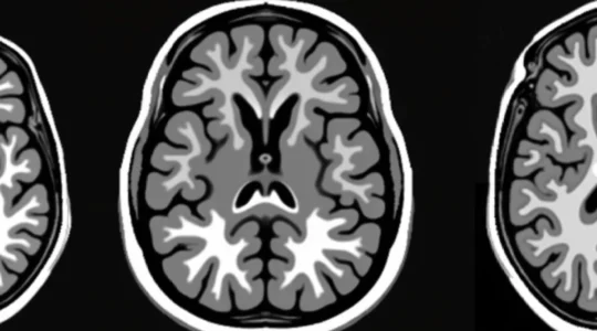 what-white-spots-on-a-brain-mri-may-indicate