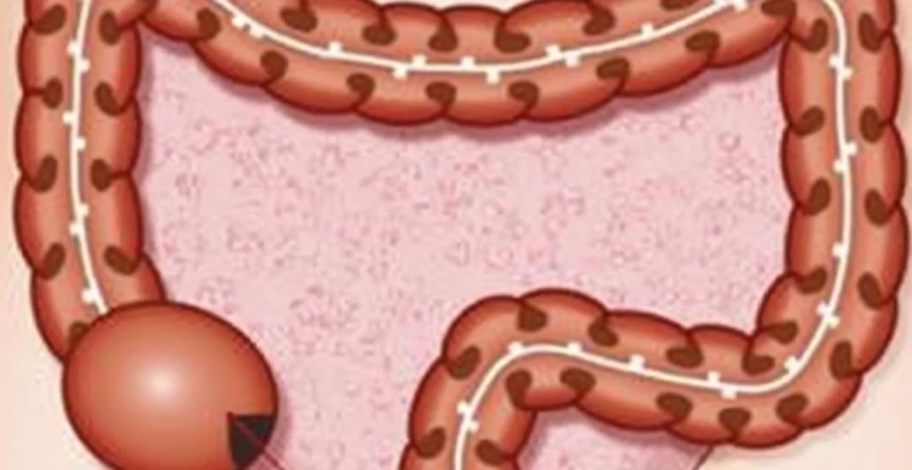 possible-causes-of-a-hard-lump-in-the-rectum