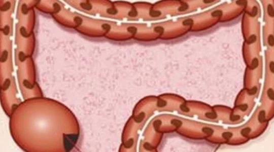 possible-causes-of-a-hard-lump-in-the-rectum